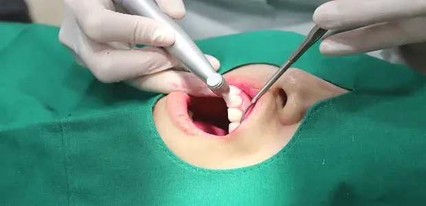 Tooth polishing