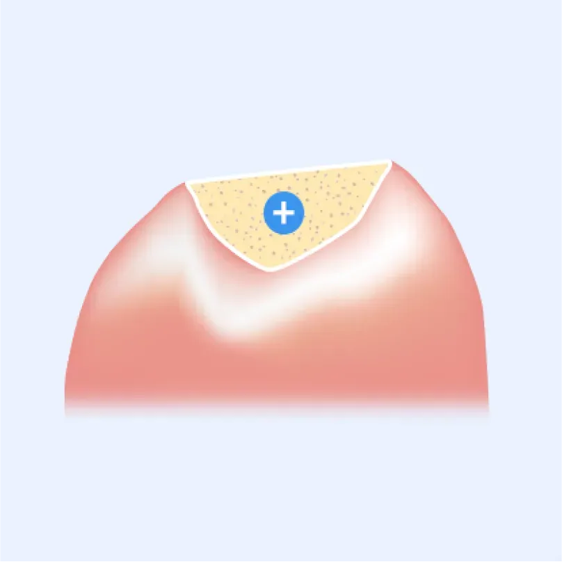 Illustration of bone graft material filling the deficient area