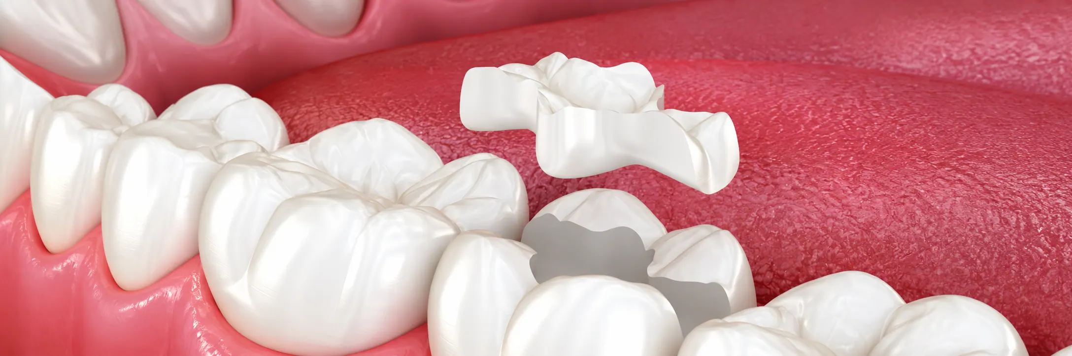 Illustration of an inlay restoration fitting into the hollow of a molar