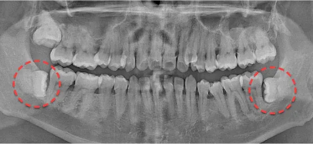 Panoramic X-ray before extraction, with the impacted wisdom teeth on both lower sides circled in red dotted lines