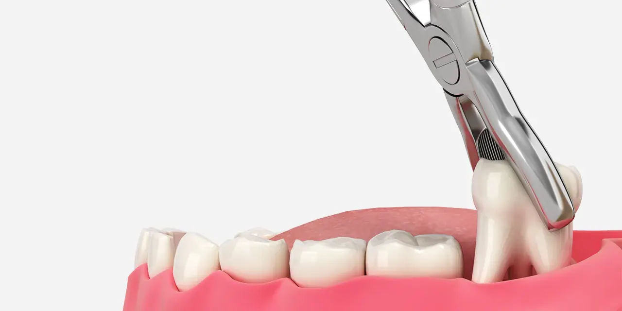 Illustration of forceps extracting a wisdom tooth behind the molars