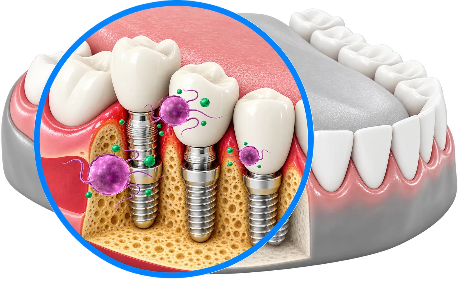 Cross-section illustration of teeth, magnifying harmful bacteria on the gums around implants