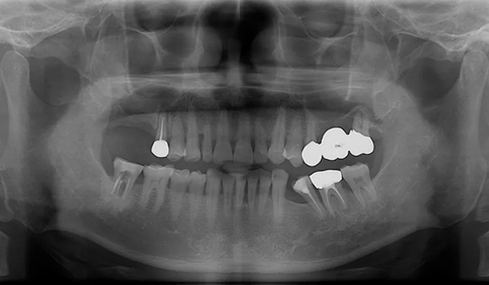 Panoramic X-ray of the Chief Director's parents before their implant surgery