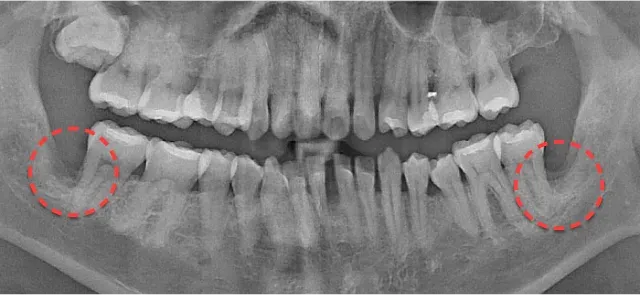 Panoramic X-ray after extraction, with both empty wisdom tooth sites circled in red dotted lines