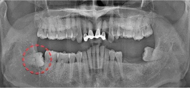 Panoramic X-ray before extraction, with the impacted lower-right wisdom tooth circled in a red dotted line