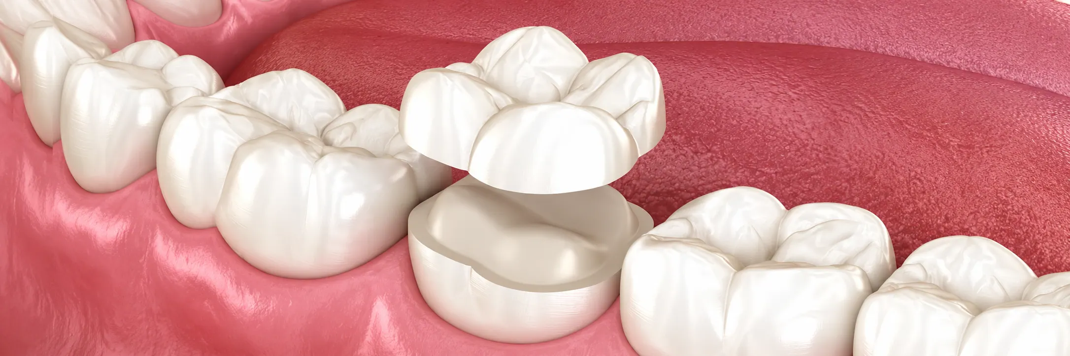 Illustration of a crown being placed over a prepared tooth