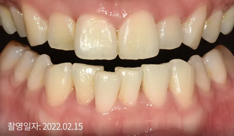 Yellowed front teeth before laminate treatment (taken Feb 15, 2022)
