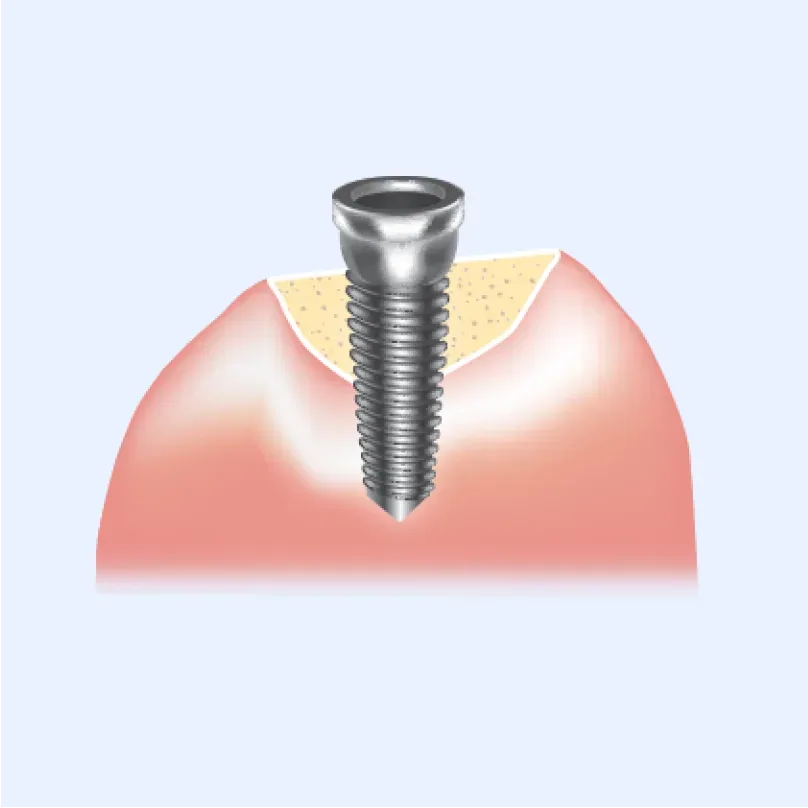 Illustration of an implant placed in the rebuilt gum bone