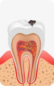 Illustration of decay spreading past the enamel into the dentin