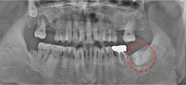 Panoramic X-ray before extraction, with the impacted lower-left wisdom tooth circled in a red dotted line