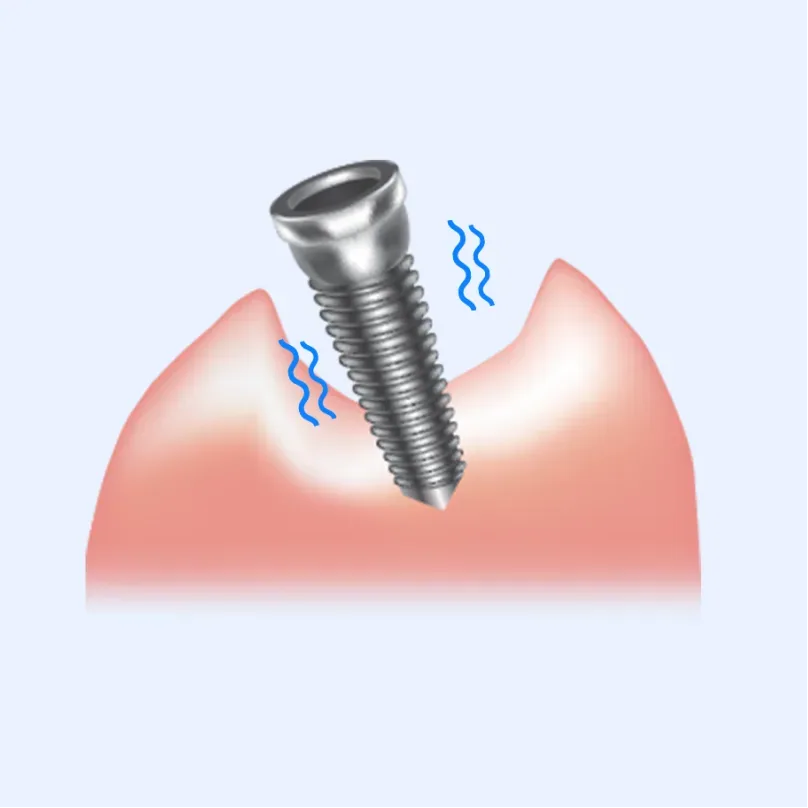 Illustration of an implant wobbling because the gum bone is insufficient