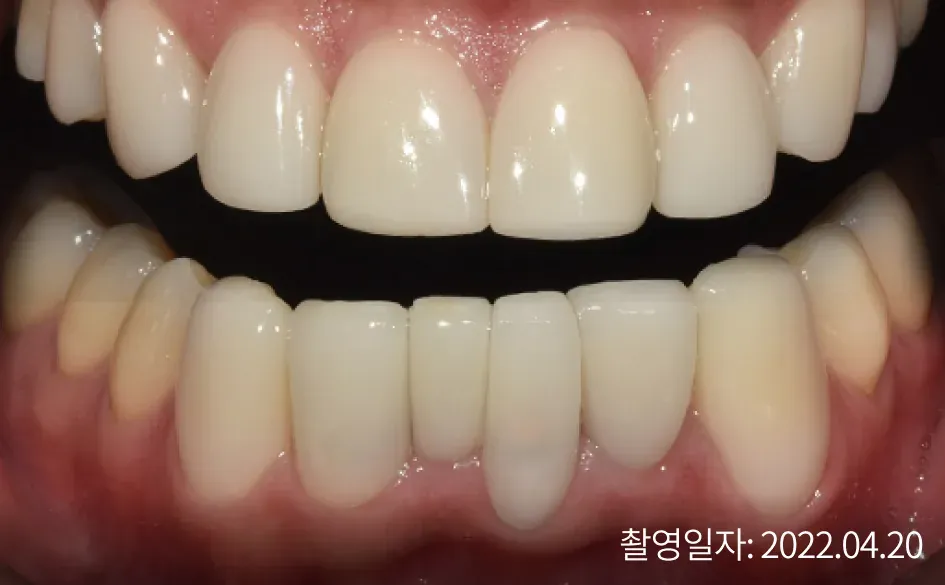 Even front teeth after laminate treatment (taken Apr 20, 2022)