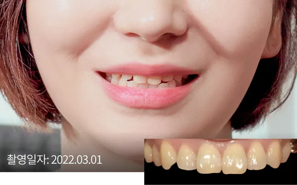 Smile and close-up of the front teeth before laminate treatment (taken Mar 1, 2022)