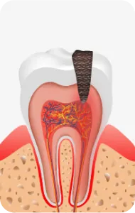 Illustration of decay spreading along the nerve to the root