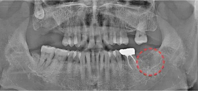 Panoramic X-ray after extraction, with the empty wisdom tooth site circled in a red dotted line