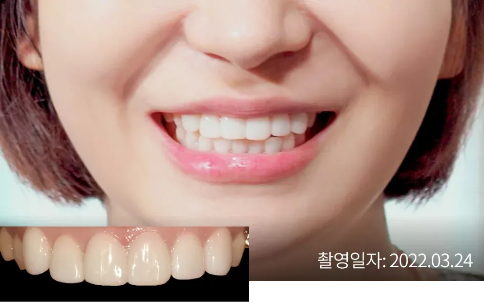 Smile and close-up of the front teeth after laminate treatment (taken Mar 24, 2022)