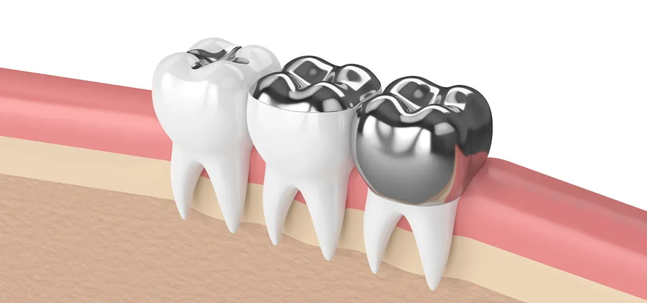 Illustration of molars with metal and zirconia crowns