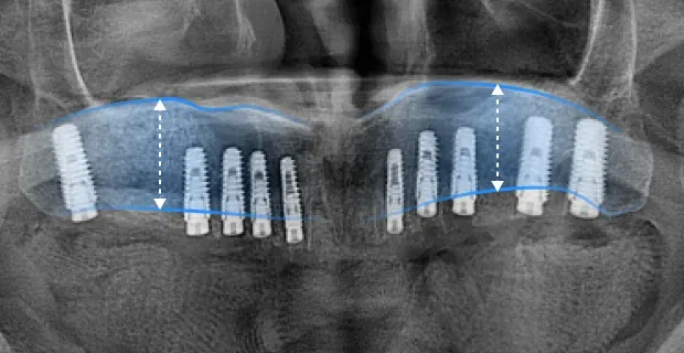 Panoramic X-ray after the sinus lift, with a blue line marking the raised boundary and the placed implants