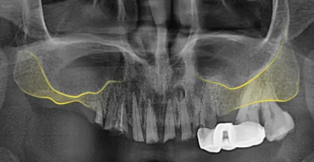 Panoramic X-ray before the sinus lift, with a yellow line marking the boundary between the gum bone and the sinus