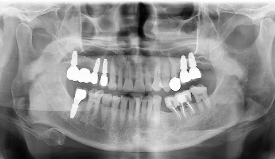 Panoramic X-ray of the Chief Director's parents one year after their implant surgery