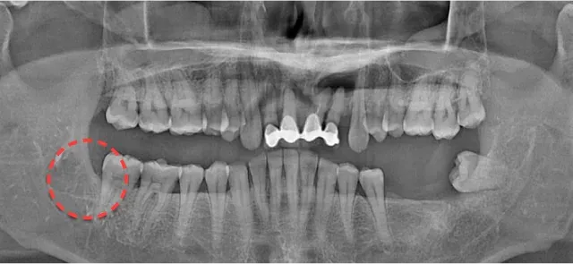 Panoramic X-ray after extraction, with the empty wisdom tooth site circled in a red dotted line