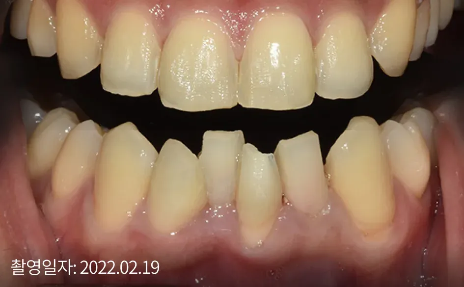 Uneven front teeth before laminate treatment (taken Feb 19, 2022)