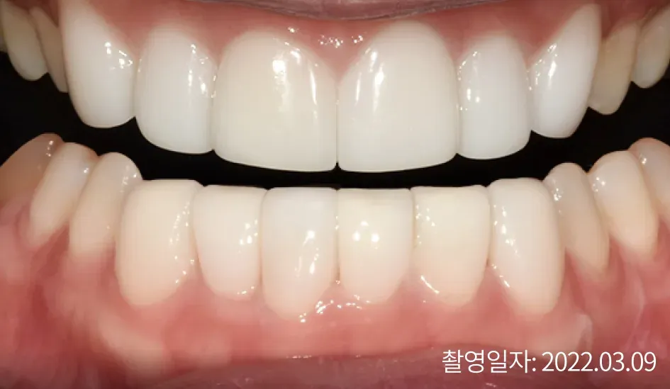 Brighter front teeth after laminate treatment (taken Mar 9, 2022)