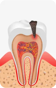Illustration of decay reaching the nerve inside the tooth