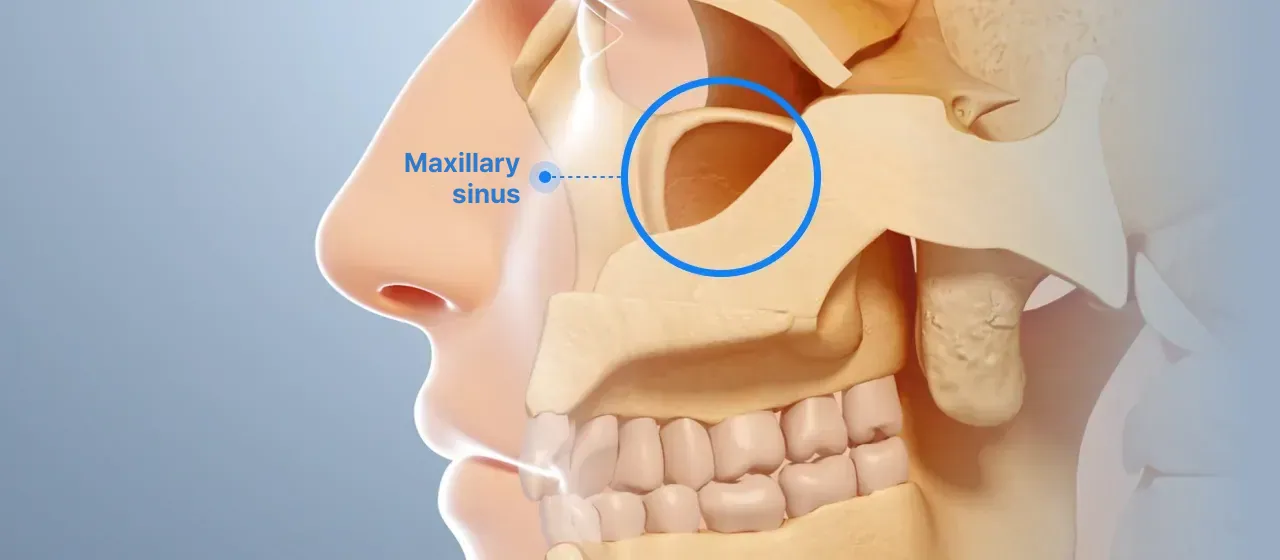 Side view of a face showing the location of the maxillary sinus, the hollow space inside the upper jawbone