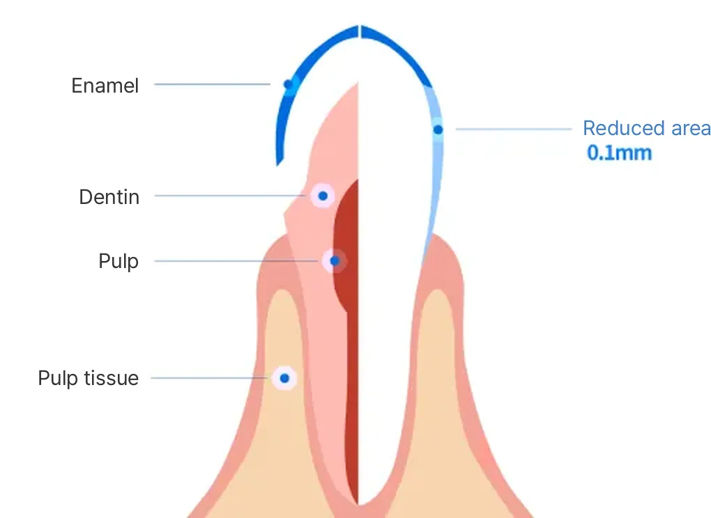 Cross-section of a tooth labeling the enamel, dentin, pulp and pulp tissue, with the 0.1mm reduced surface marked