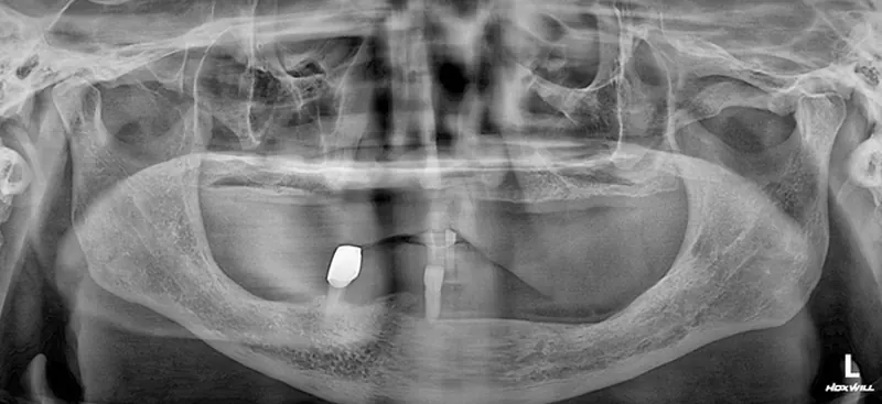 Choi** (60s), pre-surgery panoramic X-ray