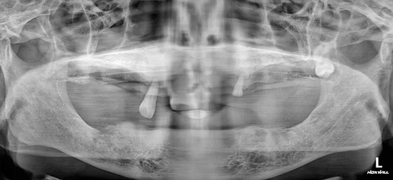 Jung** (60s), pre-surgery panoramic X-ray
