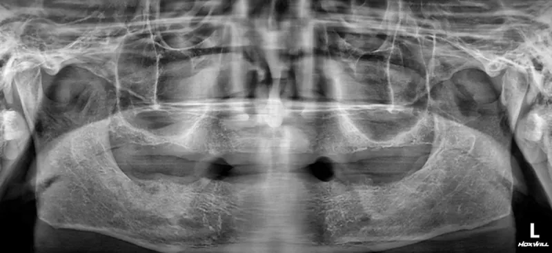 Kwon** (70s), pre-surgery panoramic X-ray