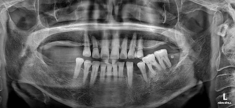 Jung** (60s), pre-surgery panoramic X-ray