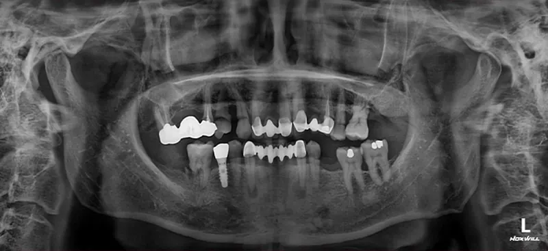 Cha** (50s), pre-surgery panoramic X-ray