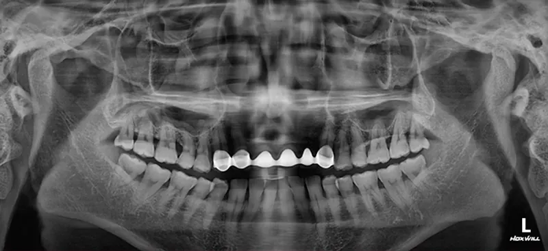 Lee** (40s), pre-surgery panoramic X-ray