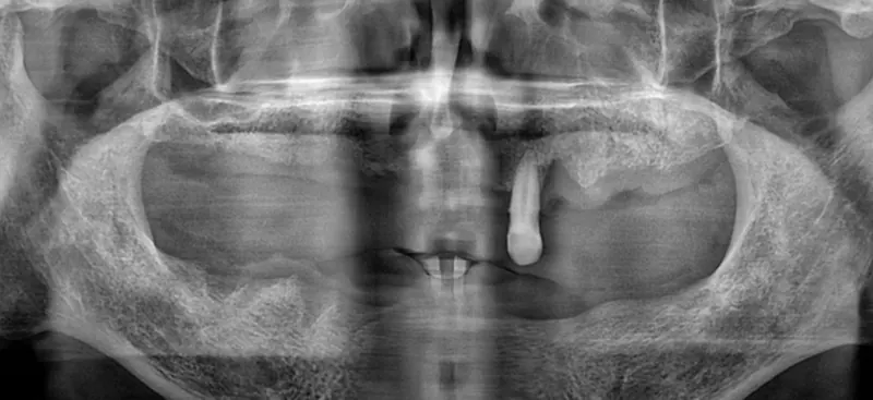 Ok** (60s), pre-surgery panoramic X-ray
