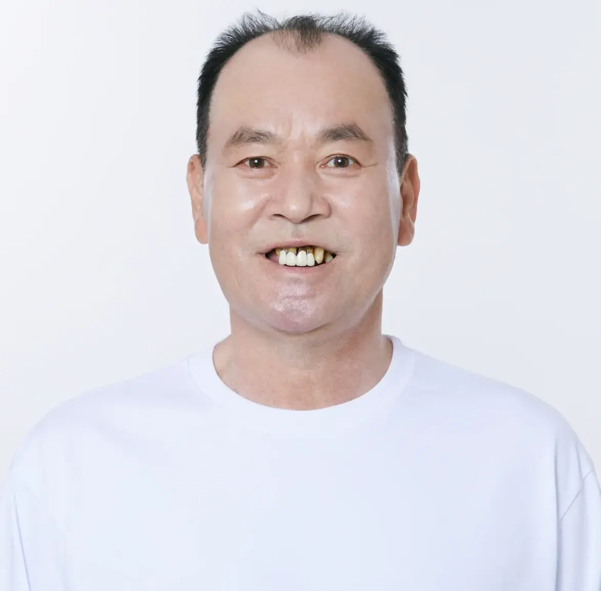 Kim** (60s), implant case (Seoul), before treatment