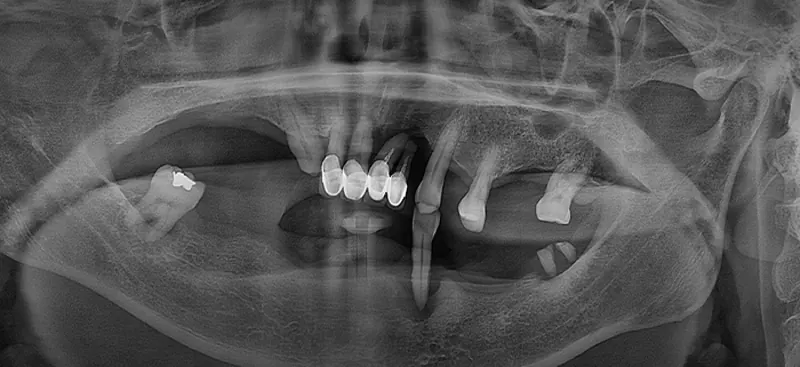 Kim** (60s), pre-surgery panoramic X-ray