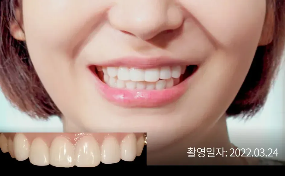 Laminate veneer case 1 (Seoul), after treatment