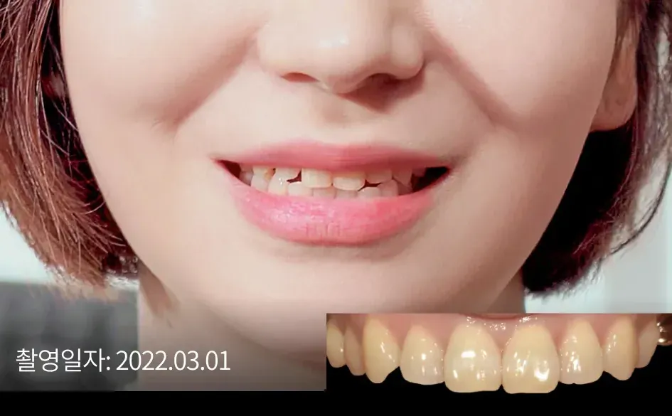 Laminate veneer case 1 (Seoul), before treatment